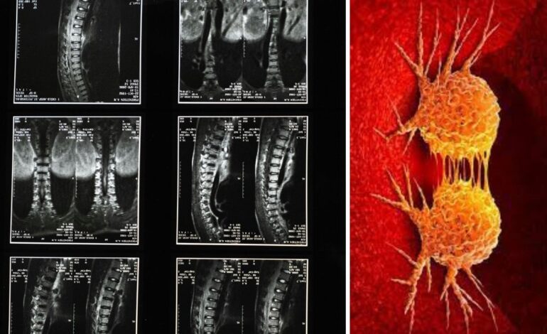 Denuncia que su madre murió después de que los médicos confundieran el cáncer con una lumbalgia