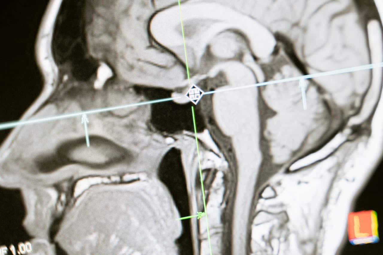 cómo afecta al las conexiones en cerebro cerebrales de las víctimas