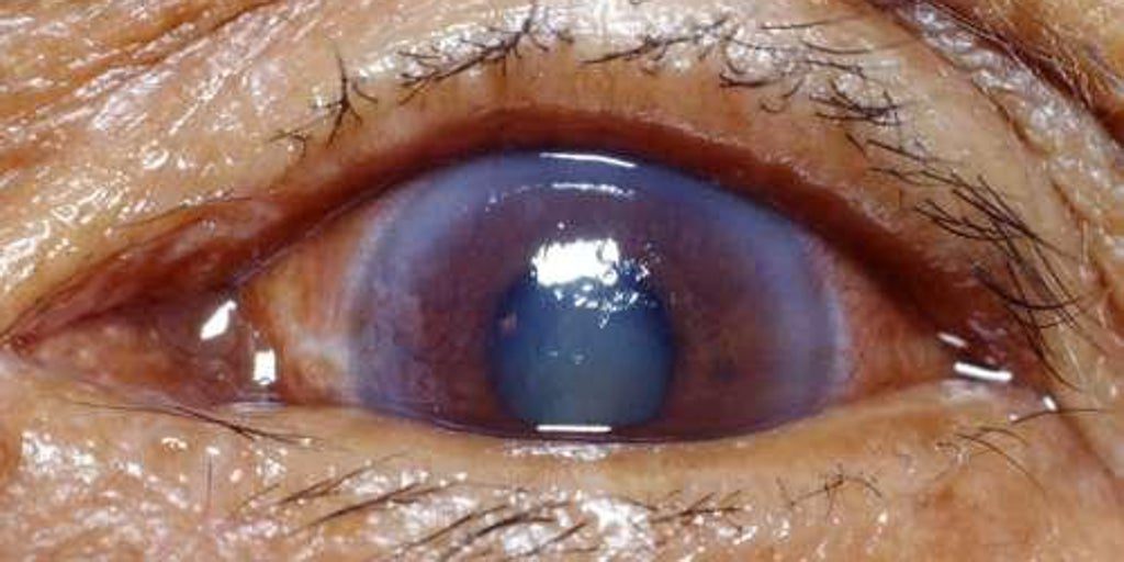 ¿Tienes más 55 años? Vigila tu colesterol ‘bueno’, podría favorecer el glaucoma