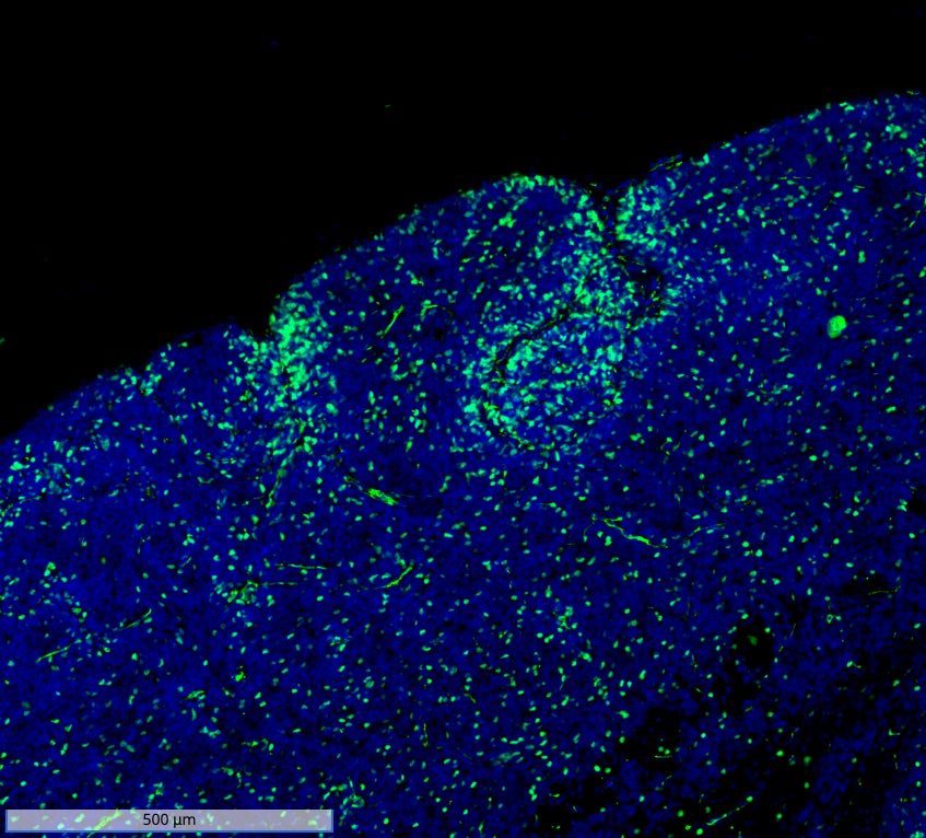 Una terapia innovadora detiene un tumor cerebral infantil antes de que se forme