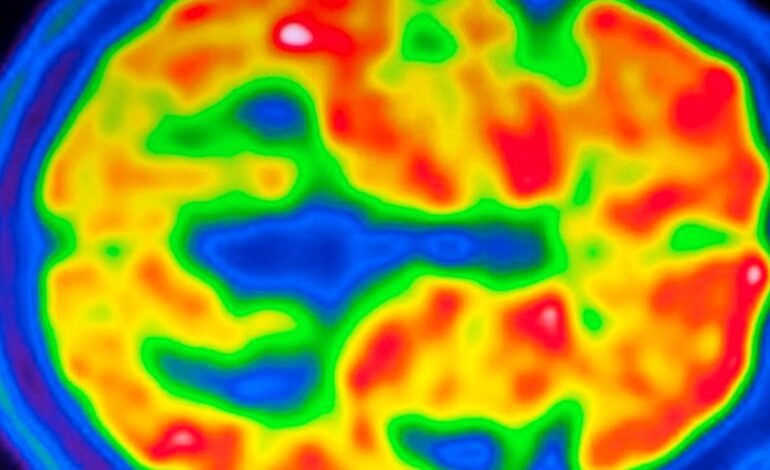 La esquizofrenia se refleja en la estructura cerebral de cada persona