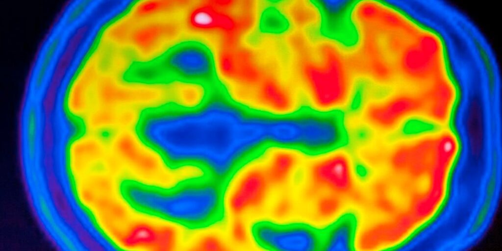 La esquizofrenia se refleja en la estructura cerebral de cada persona