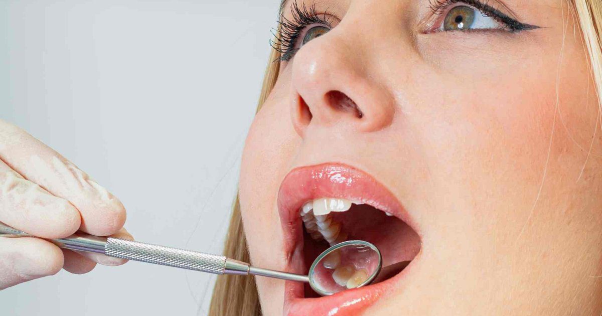El hábito casero que las odontólogas avalan para eliminar el sarro de los dientes antes de la próxima selfie