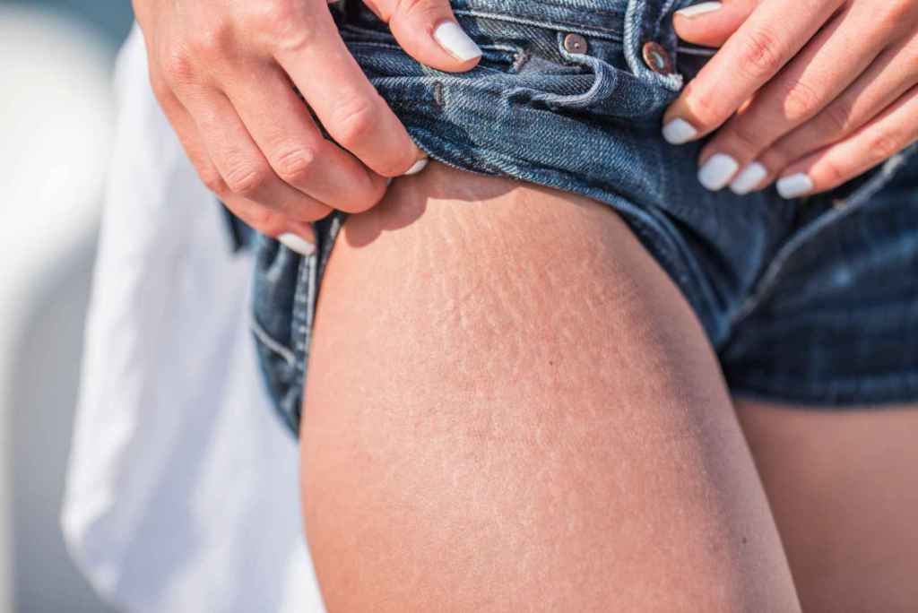 En verano, las estrías de verano pueden volverse más visibles