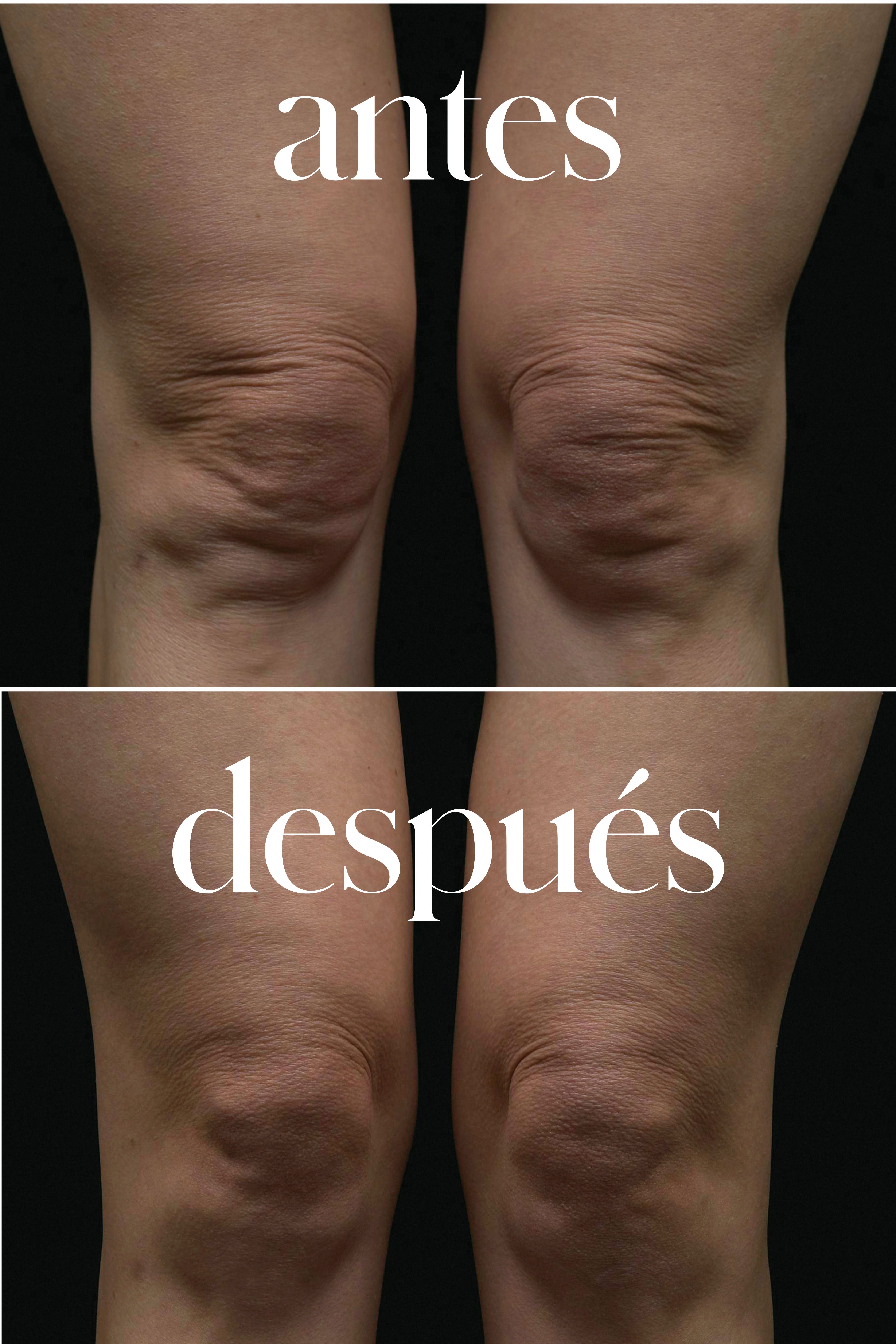 El efecto de la rodilla del tamizado de FLX.