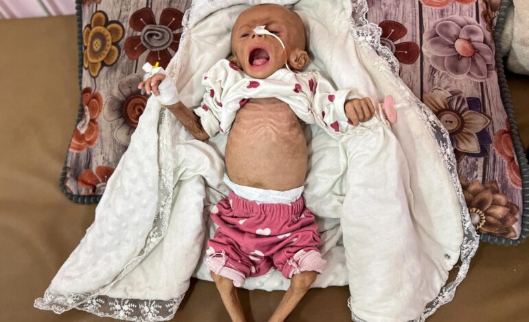 más de 110 muertos por malnutrición y fotos de niños esqueléticos