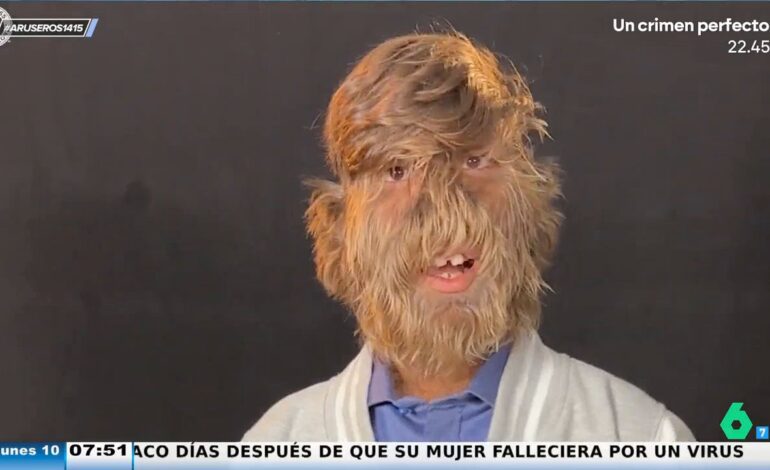 Así es la persona más peluda del mundo que ha batido el récord Guinness con tan solo 18 años