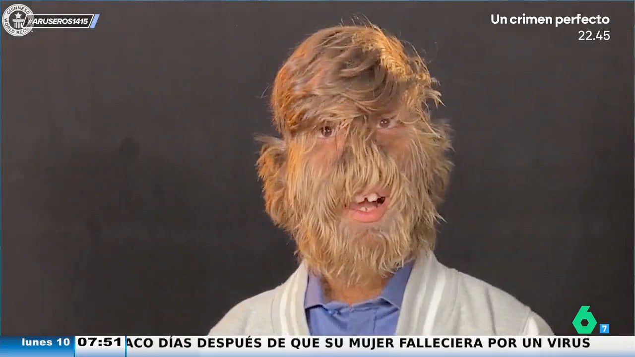 Así es la persona más peluda del mundo que ha batido el récord Guinness con tan solo 18 años