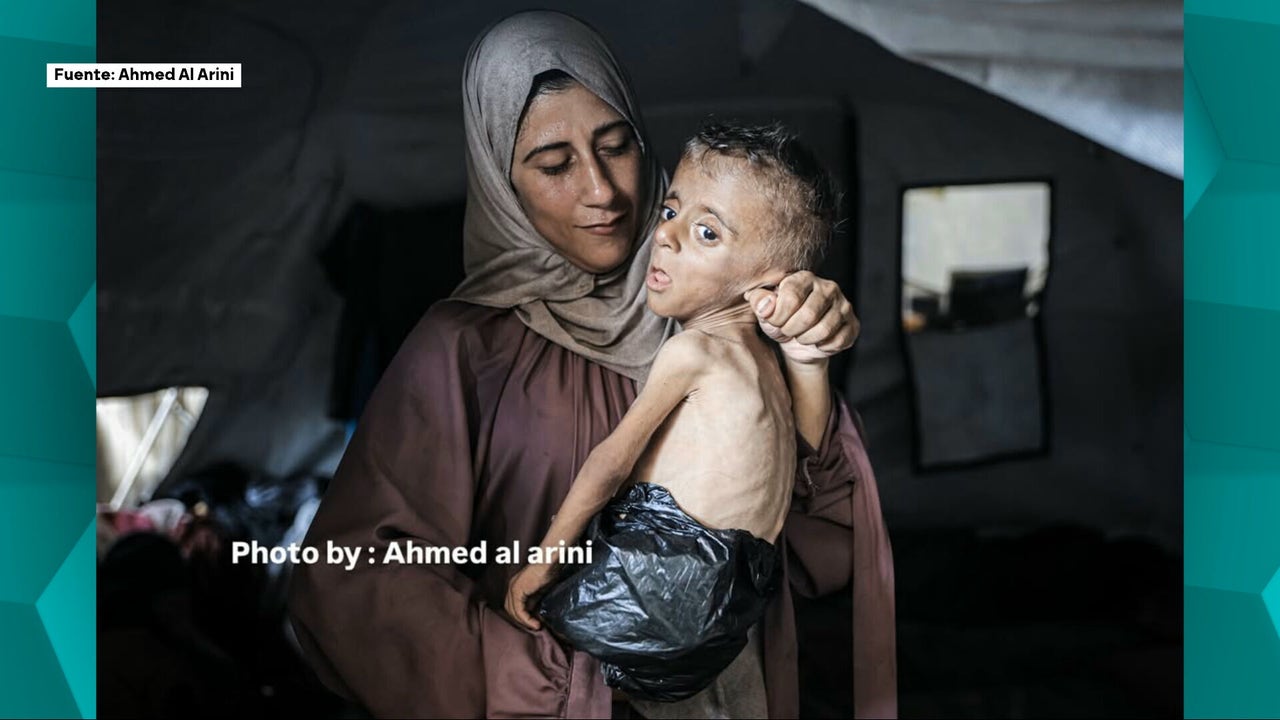Mohammed, el niño de un año que pesa como uno de tres meses y cuyo rostro muestra el horror en Gaza