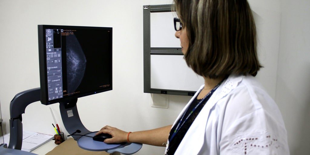 Una IA identifica a mujeres con alto riesgo de un cáncer de mama de mal pronóstico