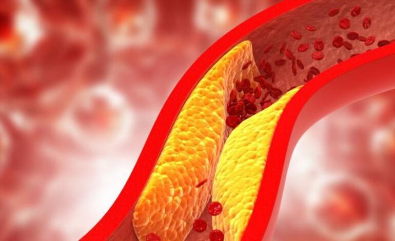 este tipo de colesterol menos conocido pero más nocivo puede causar infartos, ictus y la muerte