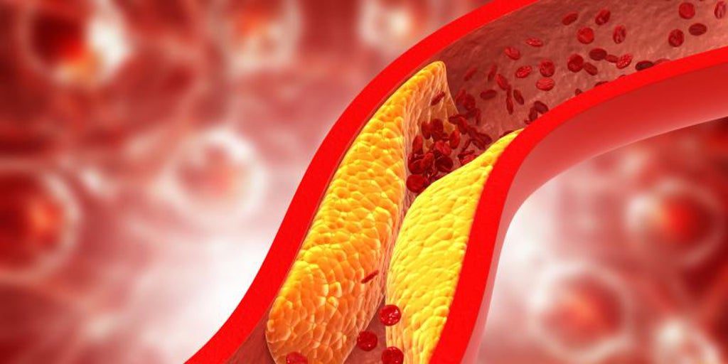 este tipo de colesterol menos conocido pero más nocivo puede causar infartos, ictus y la muerte