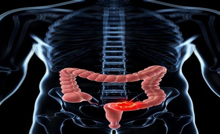 Investigadores españoles descubren por qué la inmunoterapia no funciona en el cáncer colorrectal metastásico