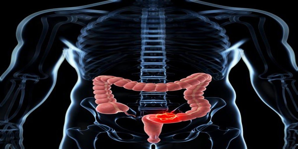 Investigadores españoles descubren por qué la inmunoterapia no funciona en el cáncer colorrectal metastásico