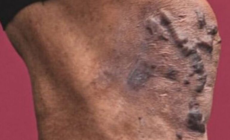 “Cada vez que miro hacia abajo, me recuerda por lo que he pasado”