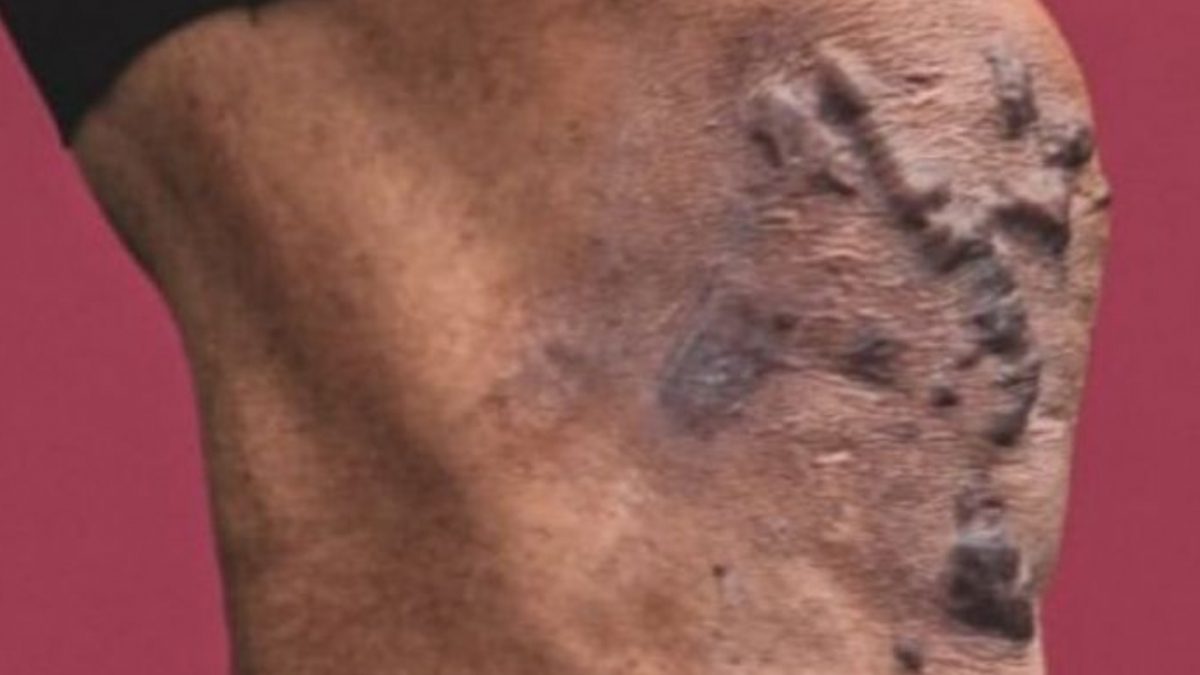 “Cada vez que miro hacia abajo, me recuerda por lo que he pasado”