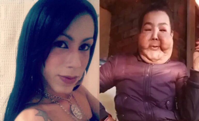 La influencer brasileña Juju do Pix inicia su reconstrucción facial tras las secuelas de una cirugía clandestina en 2017