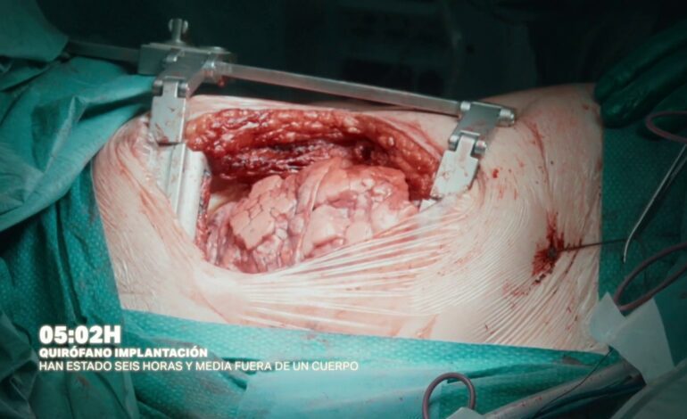 Las cámaras de Salvados asisten al «momento mágico» en el que un pulmón trasplantado se hincha por primera vez en el cuerpo del paciente