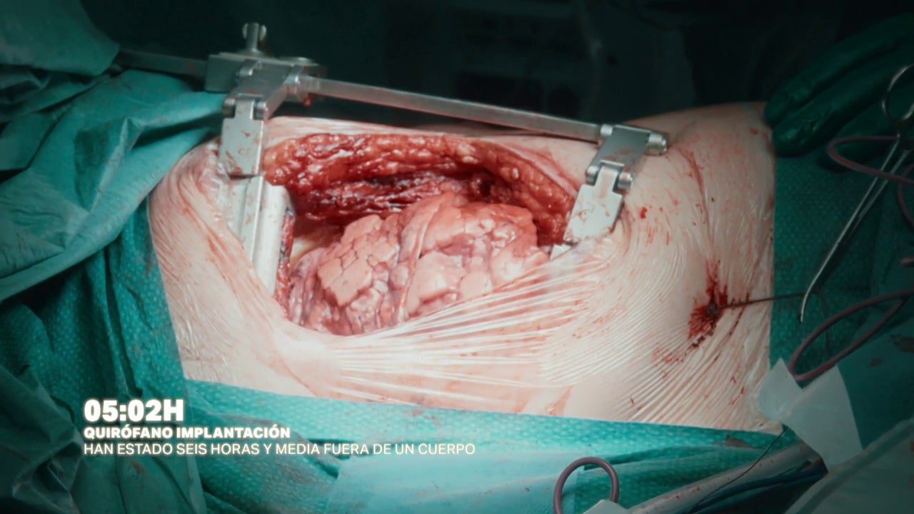 Las cámaras de Salvados asisten al «momento mágico» en el que un pulmón trasplantado se hincha por primera vez en el cuerpo del paciente