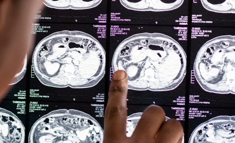 Científicos españoles descubren una enfermedad neurológica que afecta solo a 13 personas en el mundo