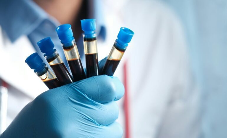 Un análisis de sangre identifica el riesgo temprano de padecer alzhéimer