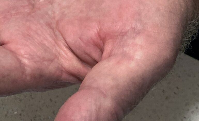 Los suplementos de melatonina no son tan inofensivos como se cree