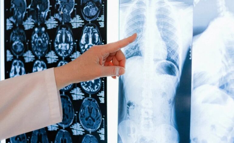 Investigadores del CSIC descubren una proteína que frena el cáncer de pulmón