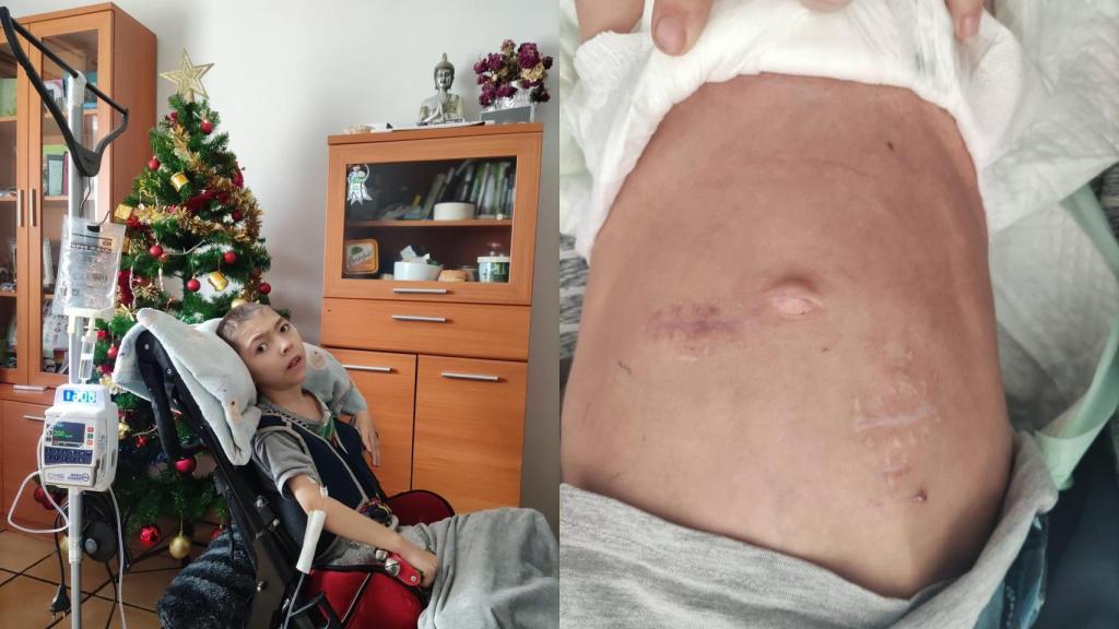 Javier tuvo que ser alimentado con sonda nasogástrica.