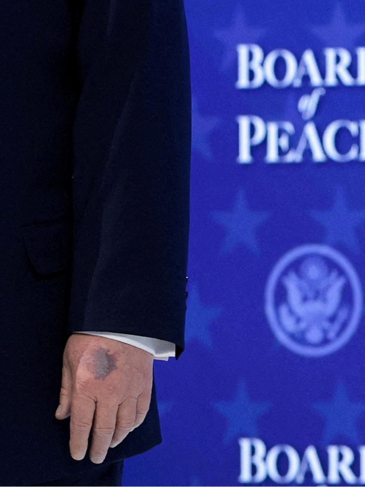La mano magullada de Donald Trump.